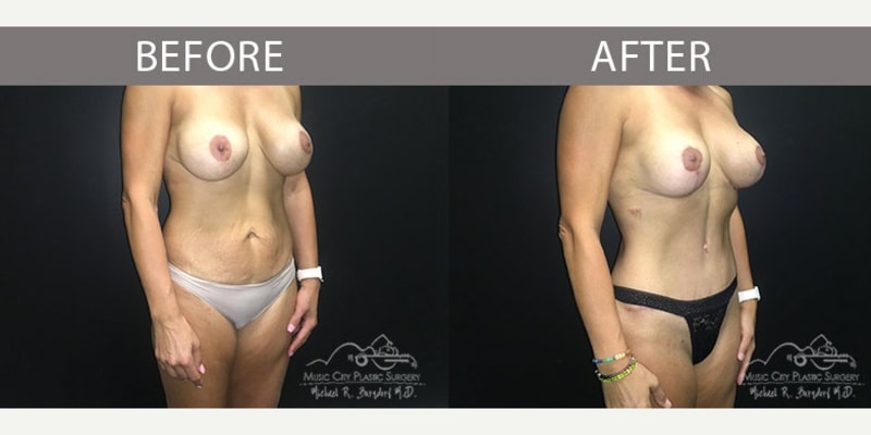 Breast Augmentation procedure image
