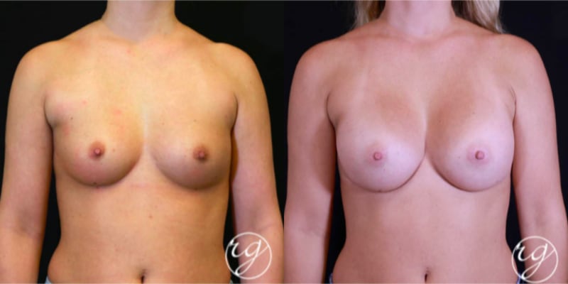 Mommy Makeover procedure image