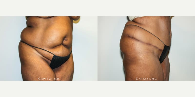 Tummy Tuck (Abdominoplasty) procedure image