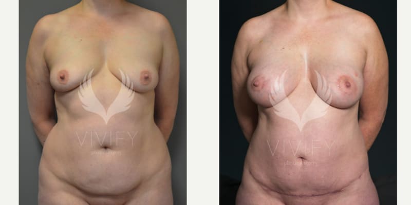 Breast Augmentation procedure image