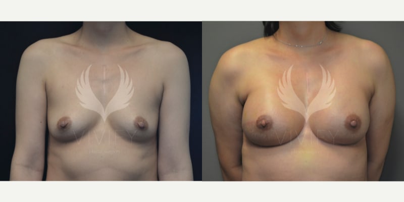 Breast Implants (Saline/Silicone) procedure image