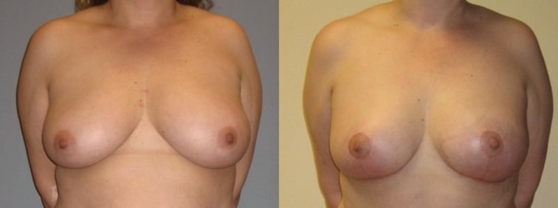 Mommy Makeover procedure image