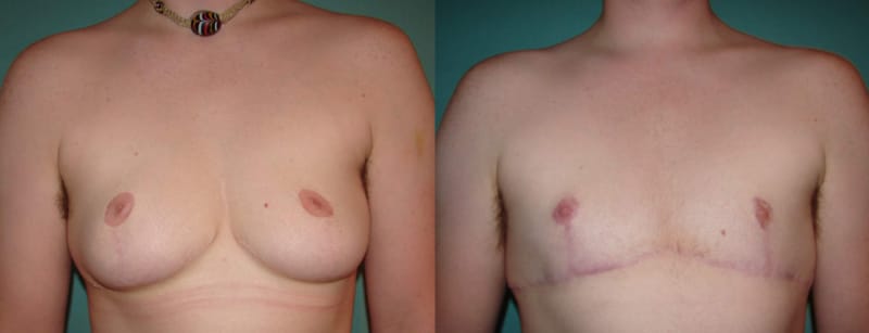 Mommy Makeover procedure image