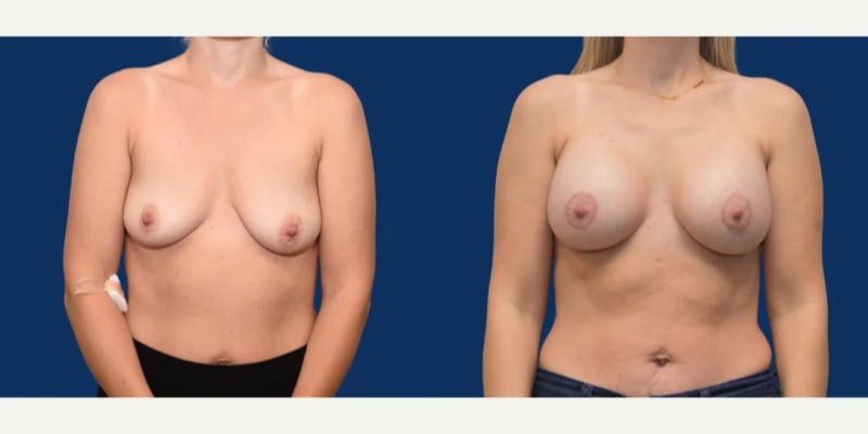 Breast Augmentation procedure image