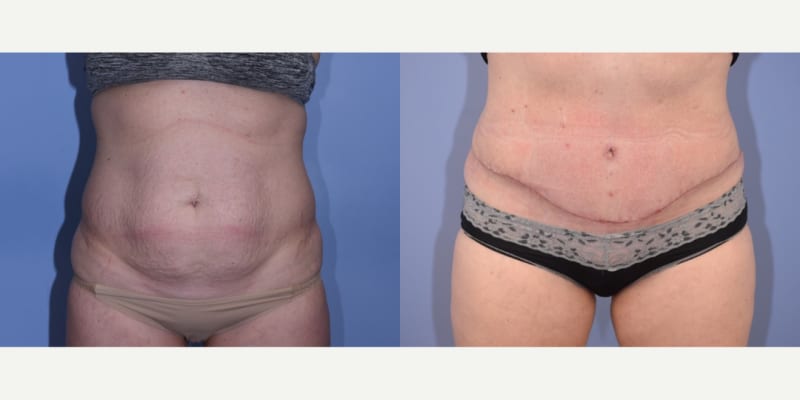 Mommy Makeover procedure image