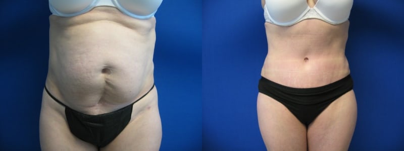 Mommy Makeover procedure image