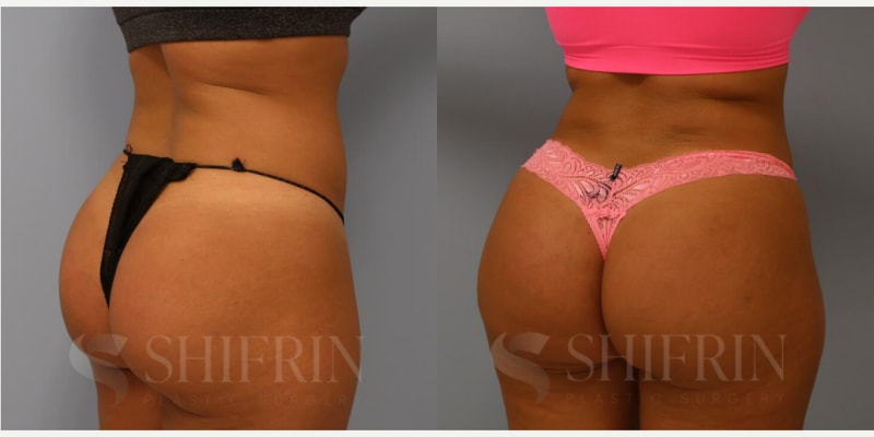 Brazilian Butt Lift (BBL) procedure image