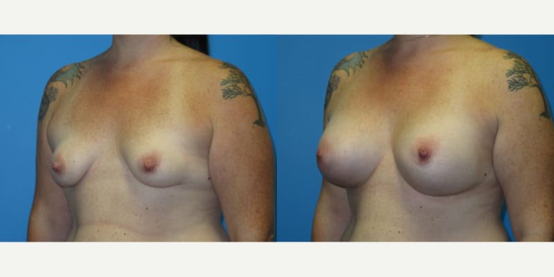 Breast Augmentation procedure image