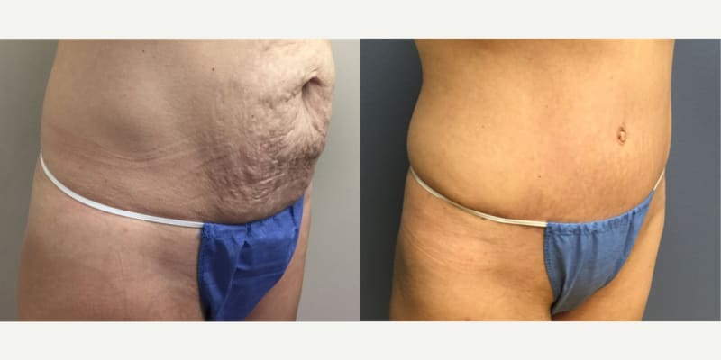 Mommy Makeover procedure image