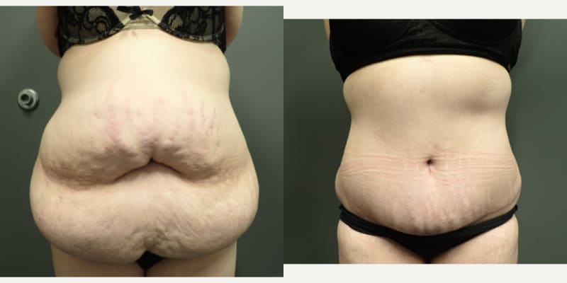 Tummy Tuck (Abdominoplasty) procedure image