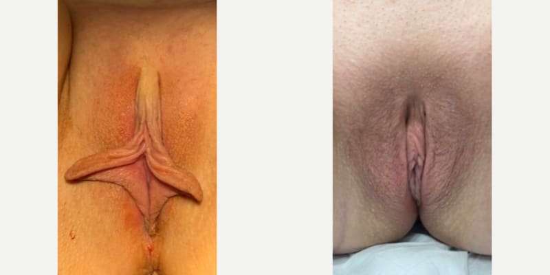 Vaginal Rejuvenation procedure image