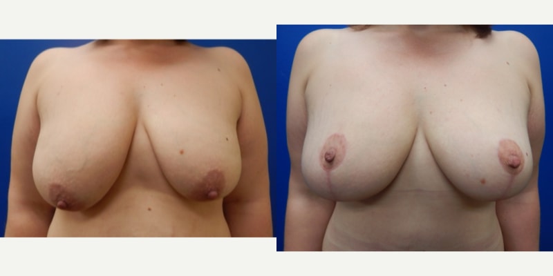 Breast Augmentation procedure image