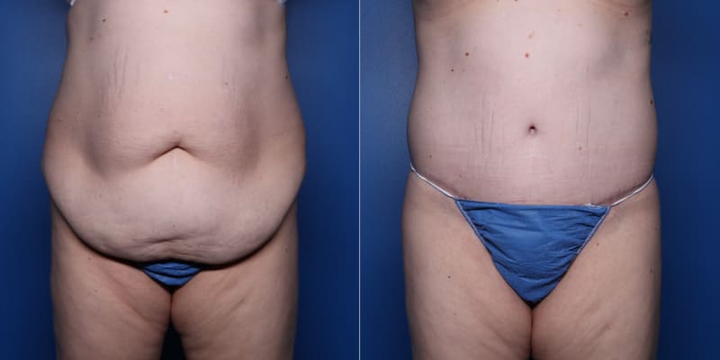 Tummy Tuck (Abdominoplasty) procedure image