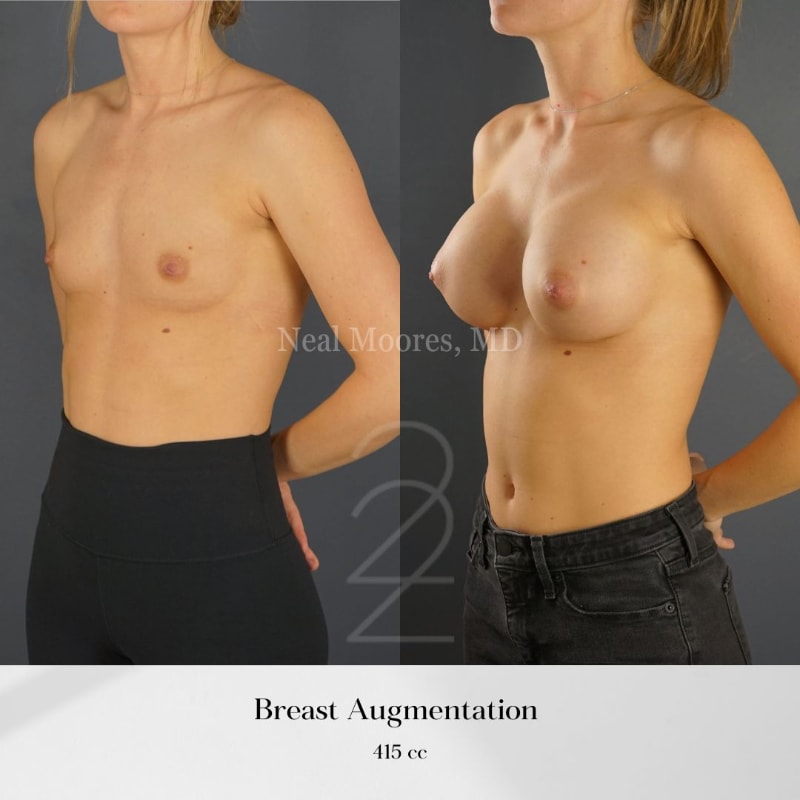 Breast Lift (Mastopexy) procedure image