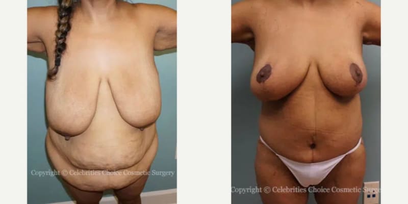 Mommy Makeover procedure image