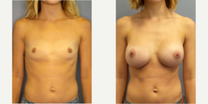 Breast Augmentation procedure image