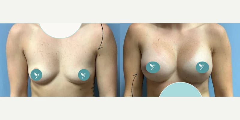 Breast Augmentation procedure image