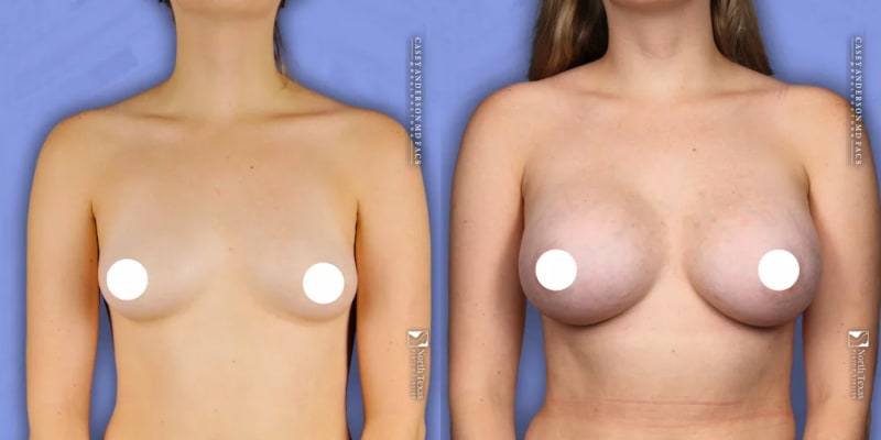Breast Augmentation procedure image