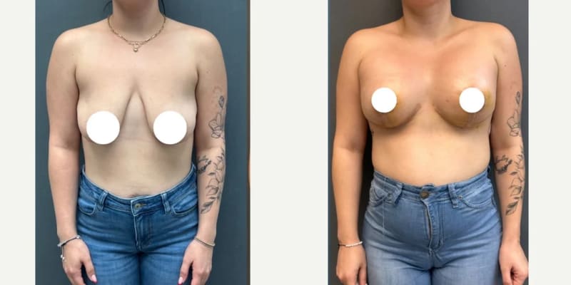 Mommy Makeover procedure image