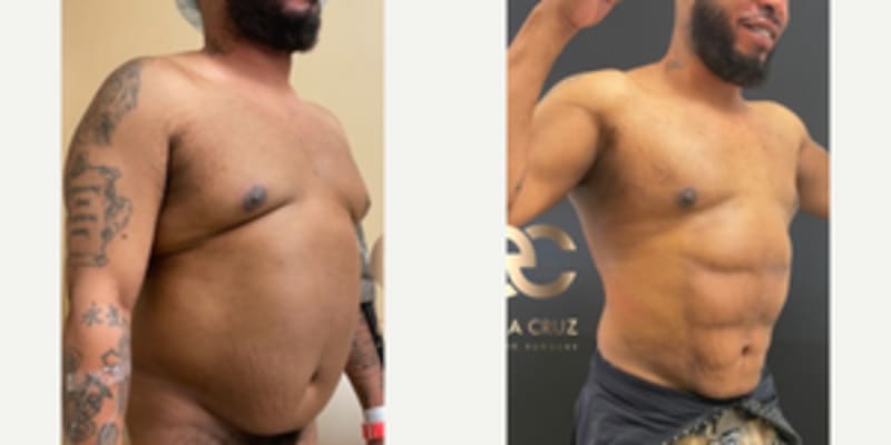 Body Lift procedure image