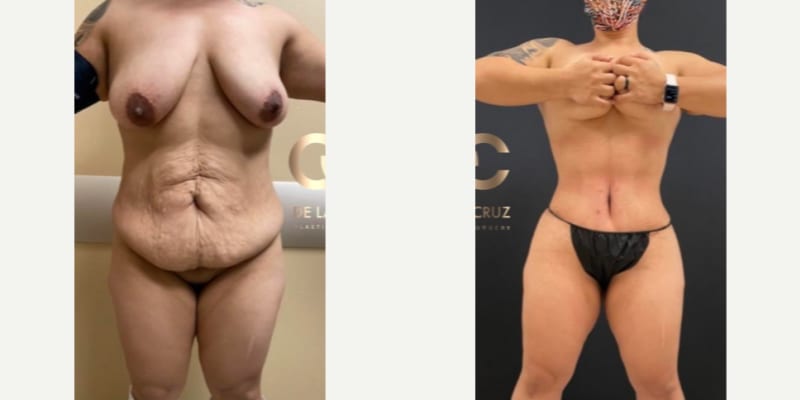 Mommy Makeover procedure image