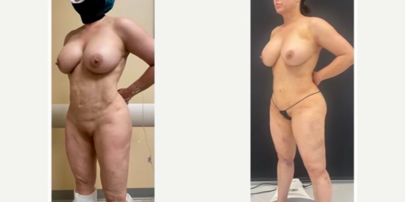 Tummy Tuck (Abdominoplasty) procedure image