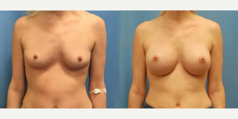 Breast Augmentation procedure image