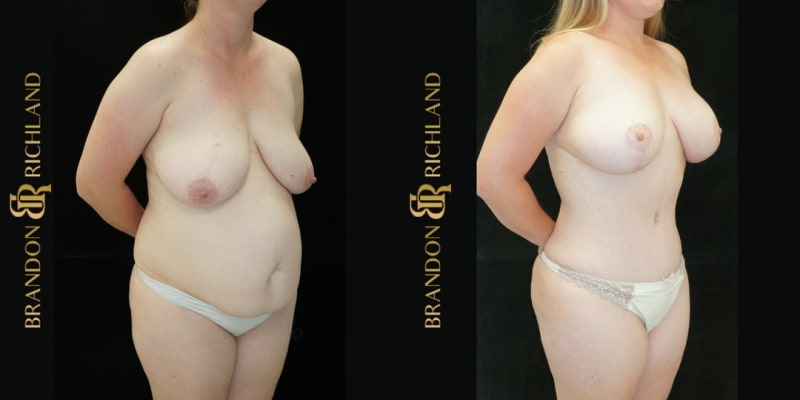 Breast Augmentation procedure image