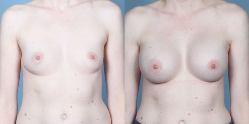 Mommy Makeover procedure image