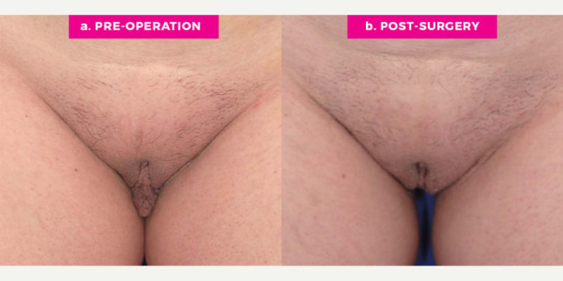 Vaginal Rejuvenation procedure image