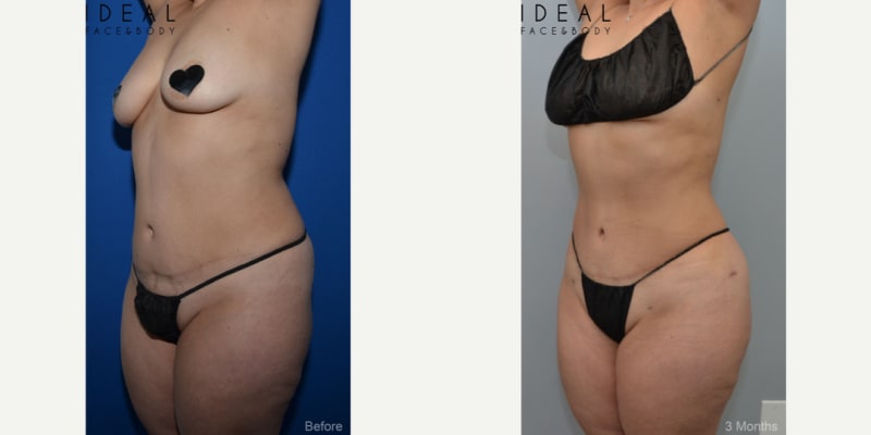 Lipo 360 procedure image