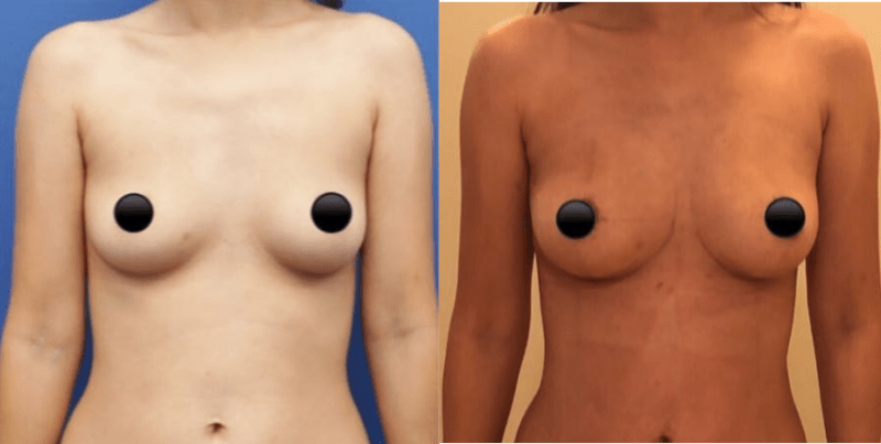 Breast Augmentation procedure image
