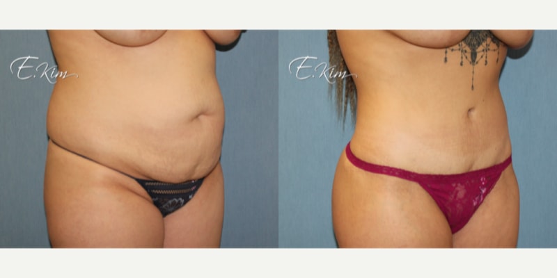 Mommy Makeover procedure image