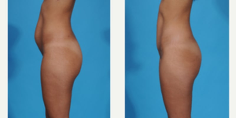 Skin Tightening procedure image