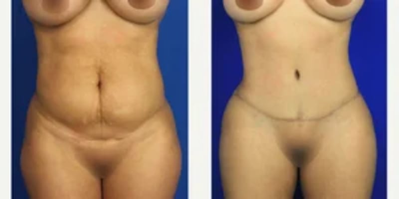 Mommy Makeover procedure image