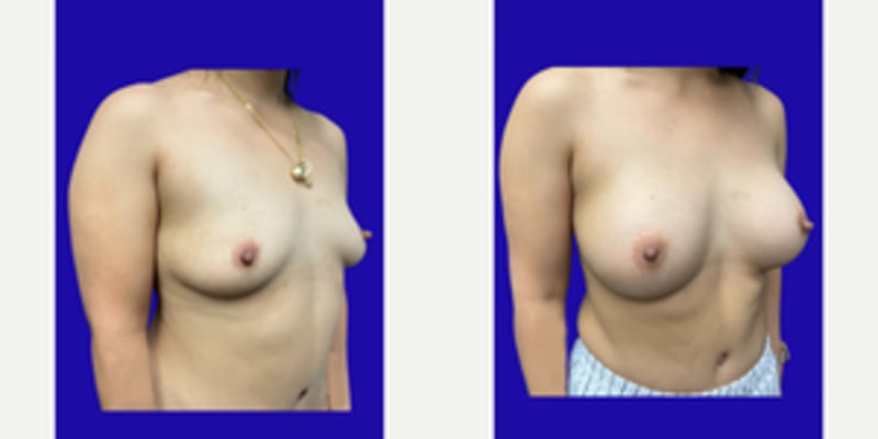 Breast Augmentation procedure image