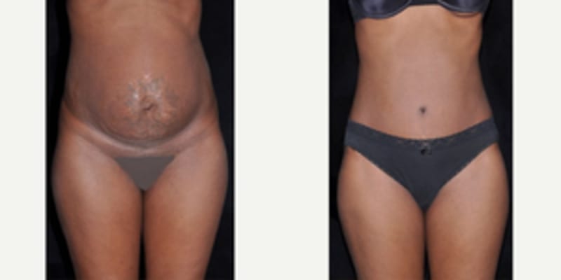 Tummy Tuck (Abdominoplasty) procedure image