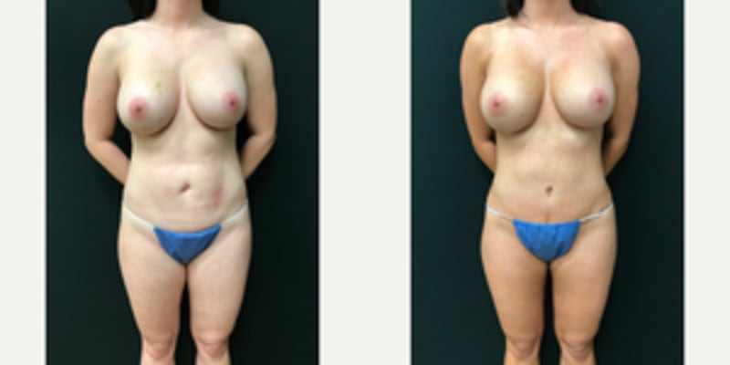 Tummy Tuck (Abdominoplasty) procedure image