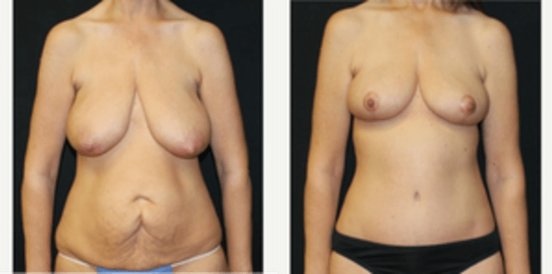 Breast Augmentation procedure image