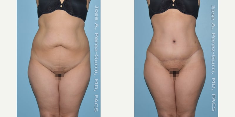 Skin Tightening procedure image