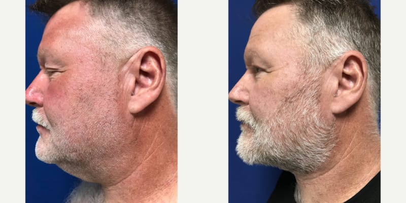 Facelift procedure image