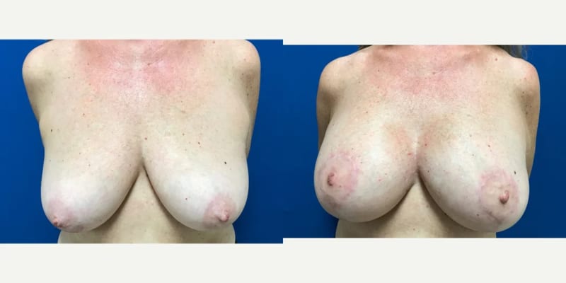 Breast Augmentation procedure image