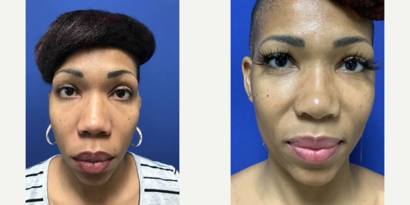 Rhinoplasty (Nose Job) procedure image