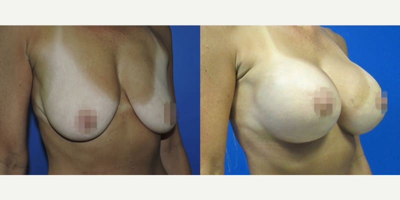 Breast Augmentation procedure image