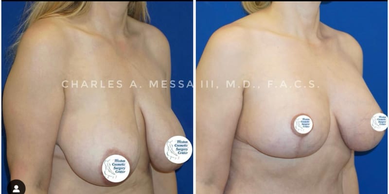 Breast Augmentation procedure image