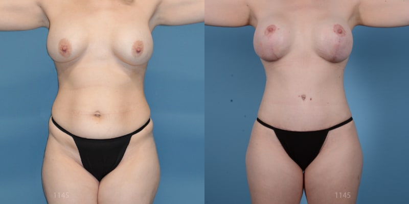 Breast Augmentation procedure image