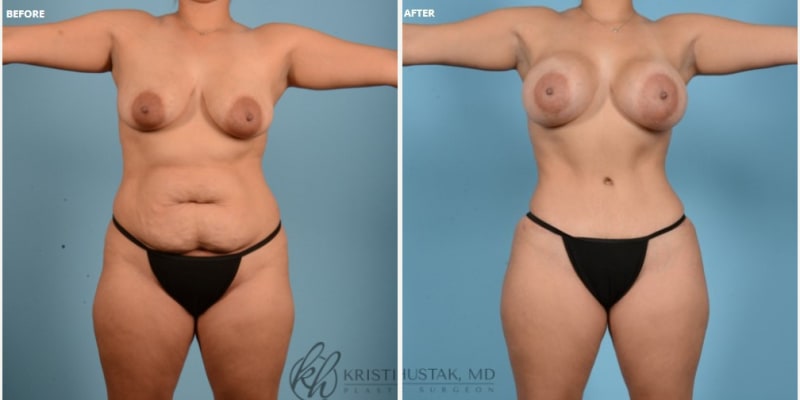 Mommy Makeover procedure image