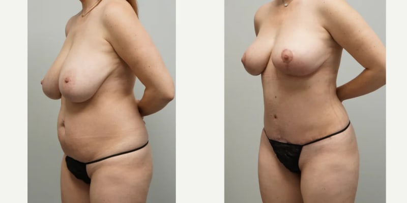 Skin Tightening procedure image