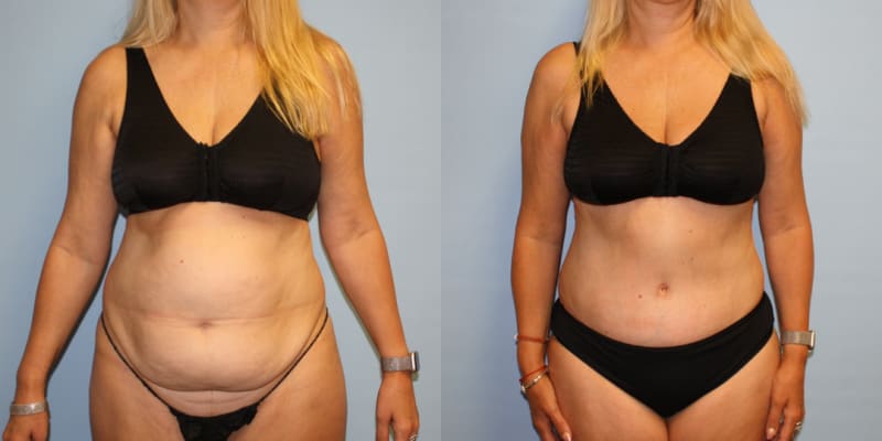 Skin Tightening procedure image