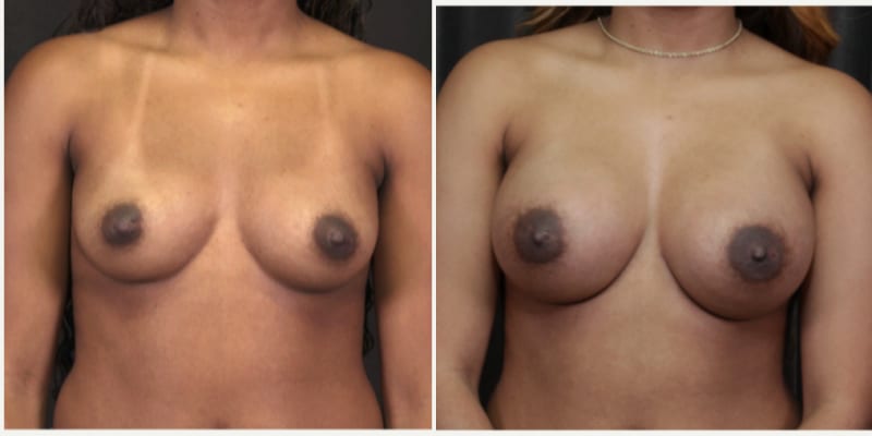 Breast Augmentation procedure image